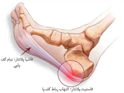 عوامل ایجاد درد پاشنه در پای چپ و راست